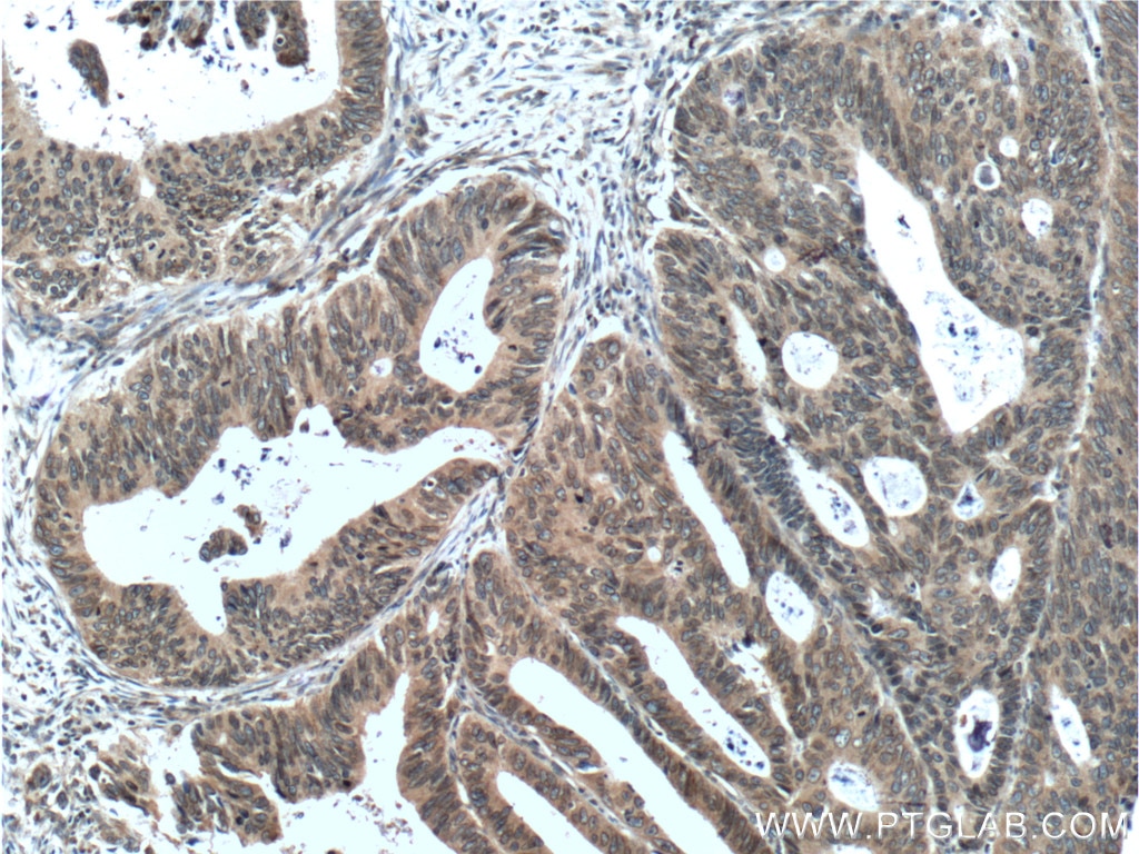 Immunohistochemistry (IHC) staining of human colon cancer tissue using NUP133 Polyclonal antibody (12405-1-AP)