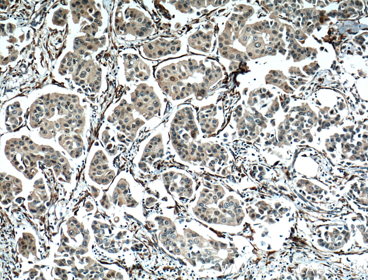 Immunohistochemistry (IHC) staining of human breast cancer tissue using NUP155 Monoclonal antibody (66359-1-Ig)