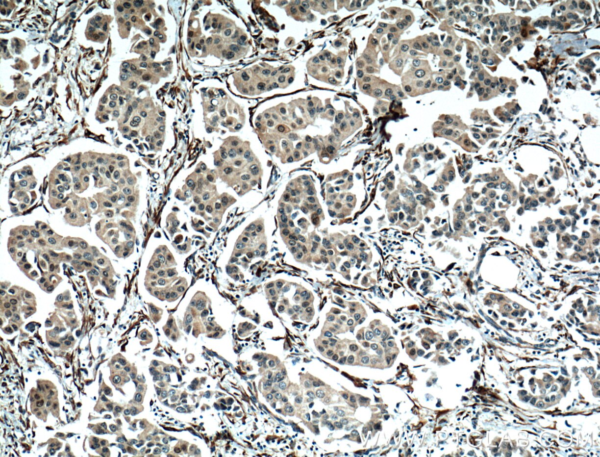 IHC staining of human breast cancer using 66359-1-Ig