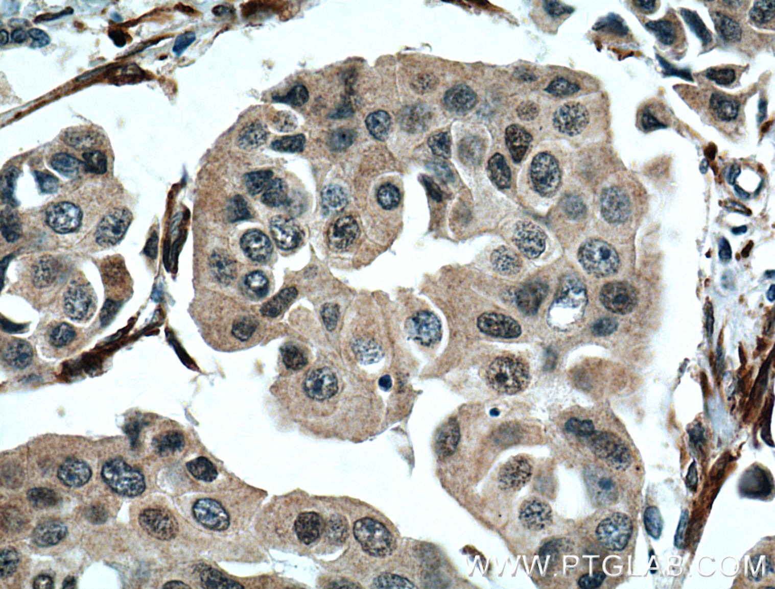 IHC staining of human breast cancer using 66359-1-Ig