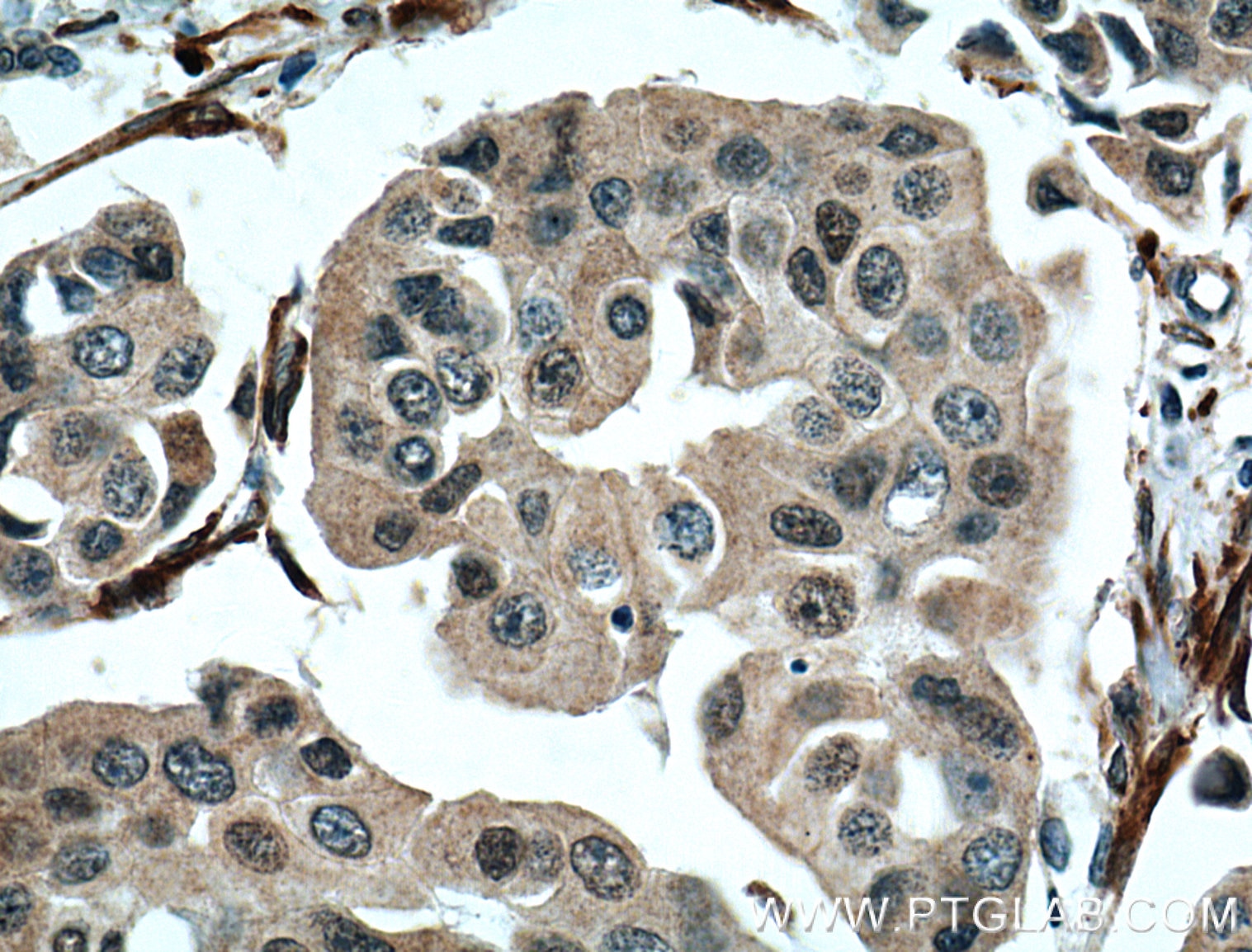 Immunohistochemistry (IHC) staining of human breast cancer tissue using NUP155 Monoclonal antibody (66359-1-Ig)