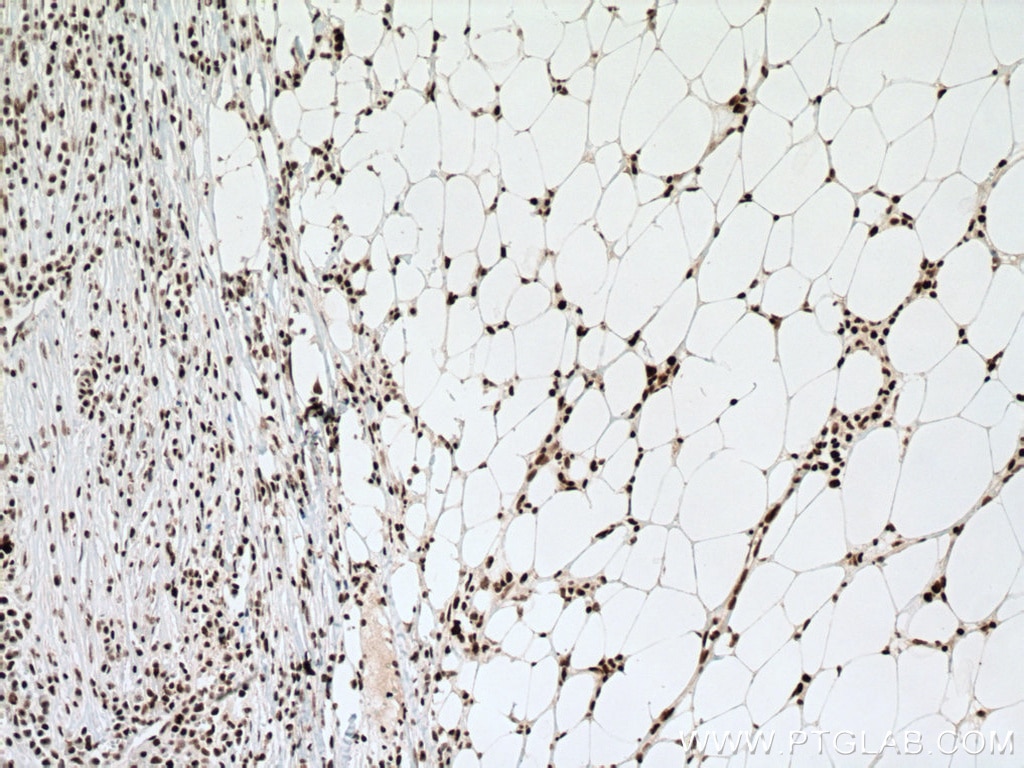 Immunohistochemistry (IHC) staining of human breast cancer tissue using NUP50 Polyclonal antibody (20798-1-AP)