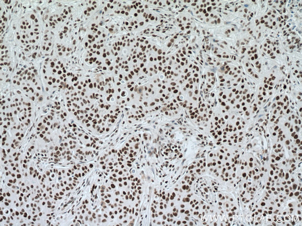 Immunohistochemistry (IHC) staining of human breast cancer tissue using NUP50 Polyclonal antibody (20798-1-AP)