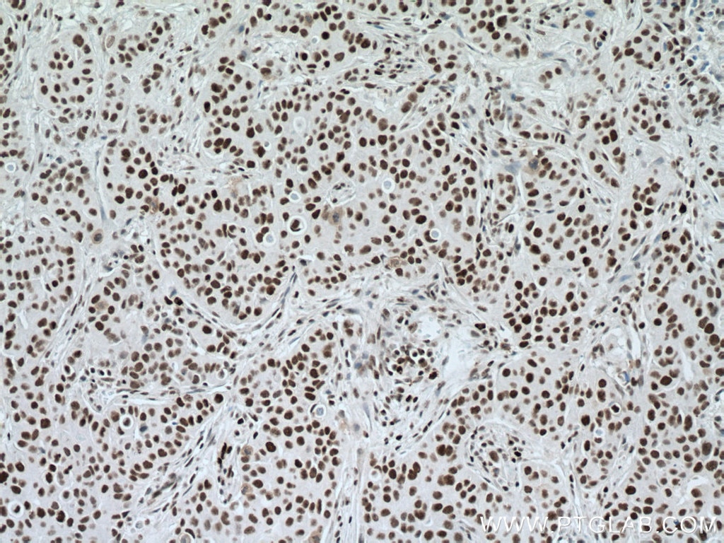 Immunohistochemistry (IHC) staining of human breast cancer tissue using NUP50 Polyclonal antibody (20798-1-AP)