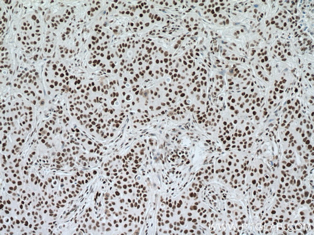 IHC staining of human breast cancer using 20798-1-AP