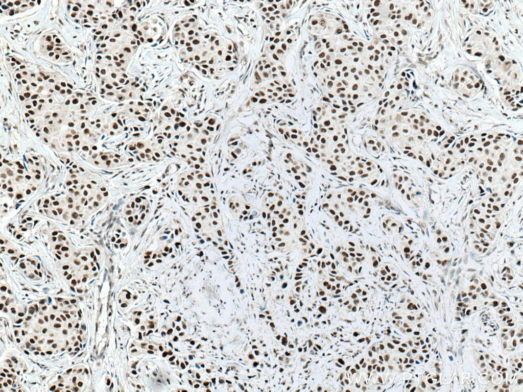 Immunohistochemistry (IHC) staining of human breast cancer tissue using NUP50 Monoclonal antibody (67001-1-Ig)