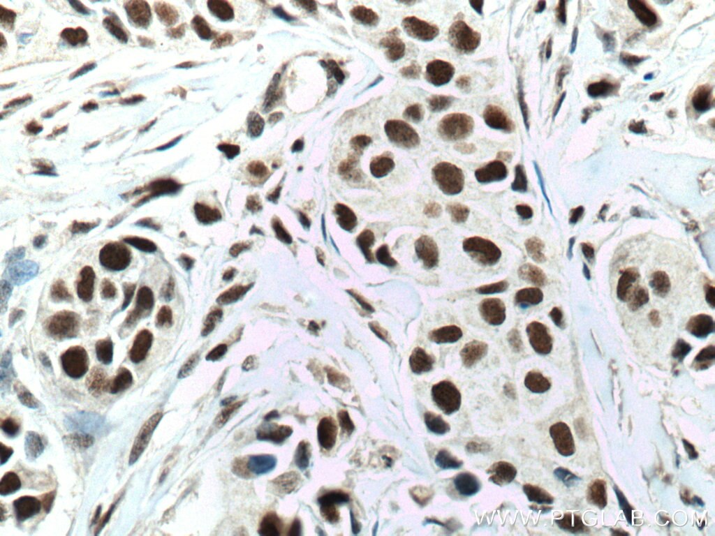 IHC staining of human breast cancer using 67001-1-Ig