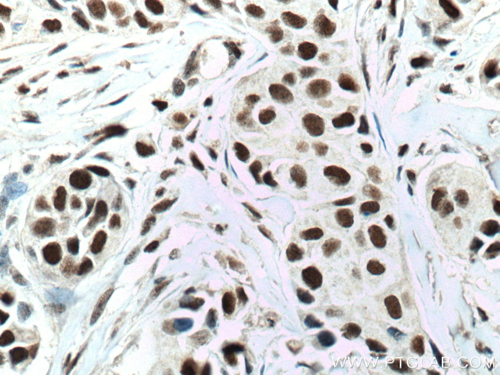 Immunohistochemistry (IHC) staining of human breast cancer tissue using NUP50 Monoclonal antibody (67001-1-Ig)