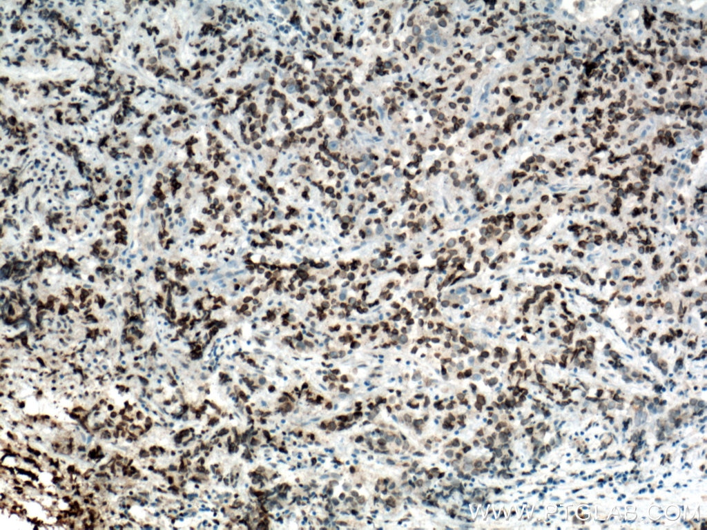 Immunohistochemistry (IHC) staining of human prostate cancer tissue using NUP62 Monoclonal antibody (66573-1-Ig)
