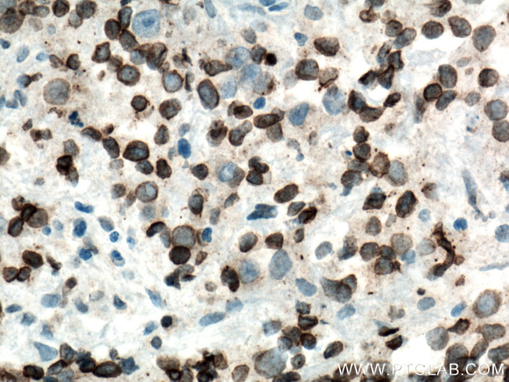 Immunohistochemistry (IHC) staining of human prostate cancer tissue using NUP62 Monoclonal antibody (66573-1-Ig)
