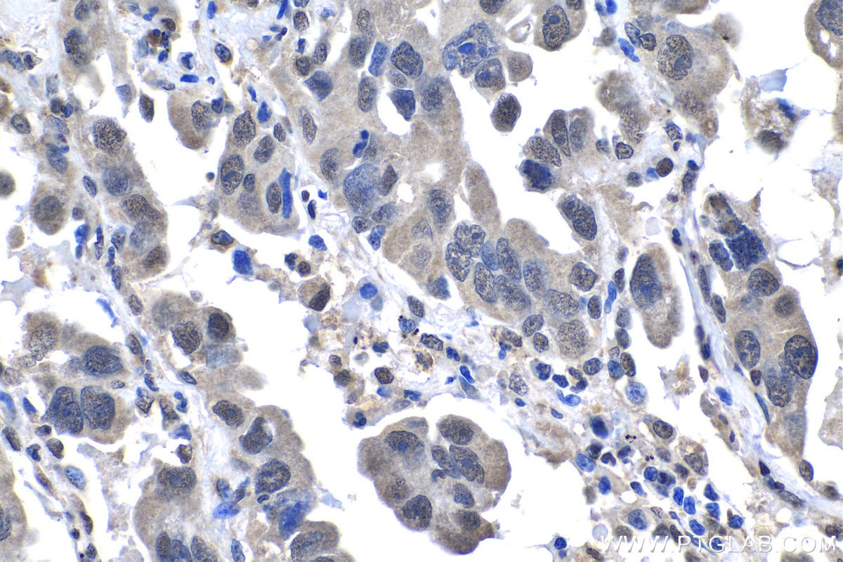 Immunohistochemistry (IHC) staining of human lung cancer tissue using NUP62CL Polyclonal antibody (25381-1-AP)