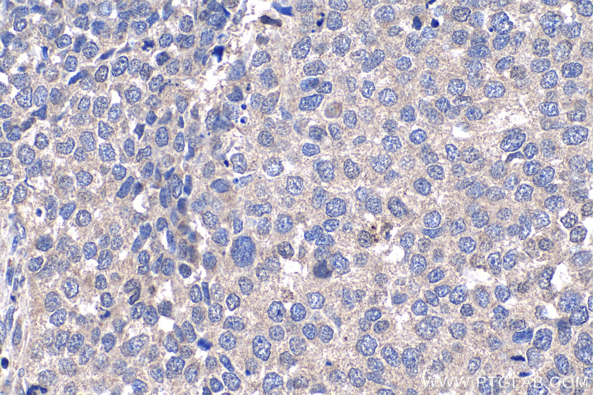 Immunohistochemistry (IHC) staining of human stomach cancer tissue using NUP85 Polyclonal antibody (15027-1-AP)