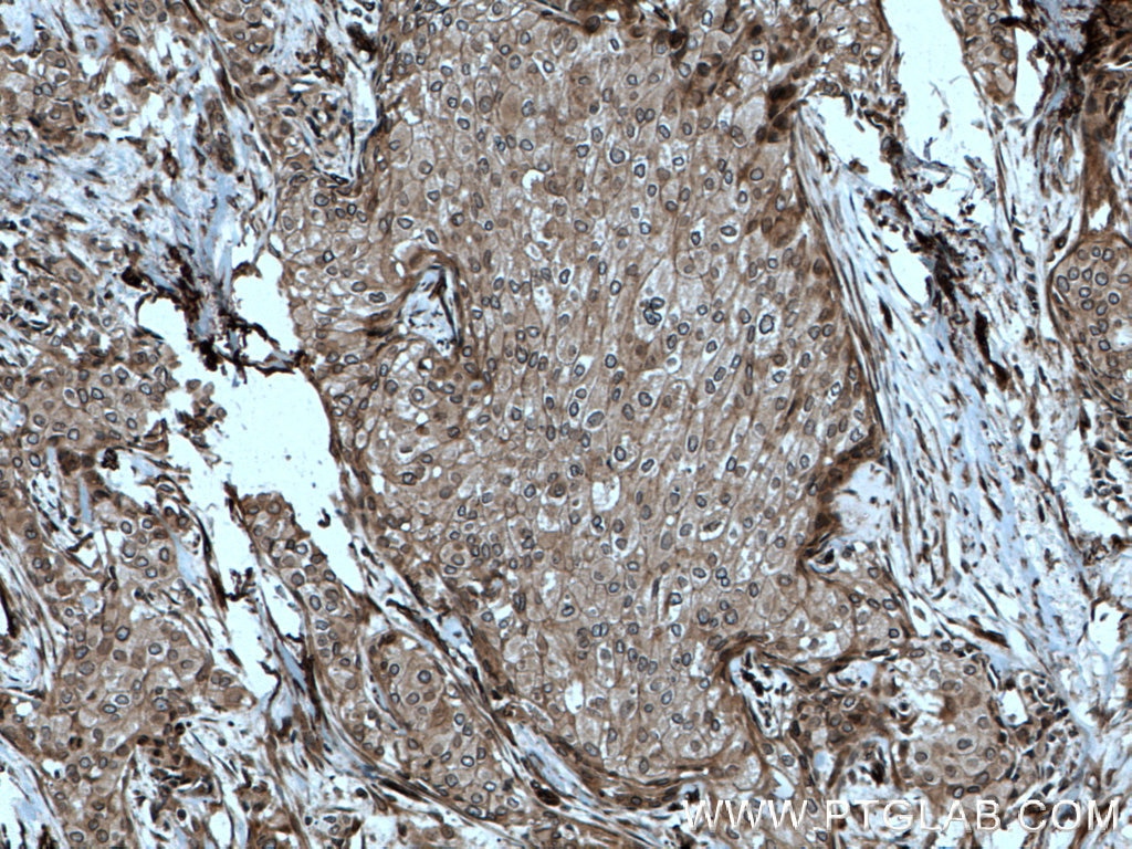 Immunohistochemistry (IHC) staining of human breast cancer tissue using NUP98-NUP96 Polyclonal antibody (12329-1-AP)