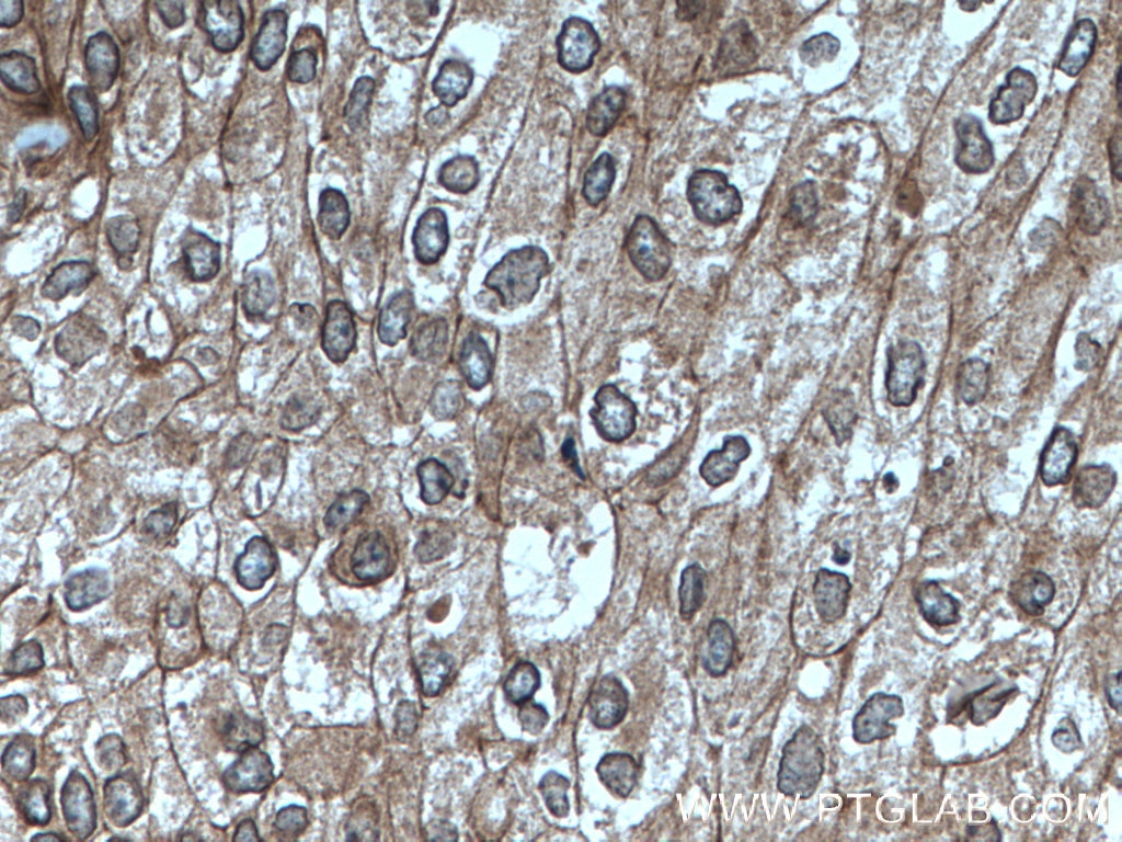 Immunohistochemistry (IHC) staining of human breast cancer tissue using NUP98-NUP96 Polyclonal antibody (12329-1-AP)