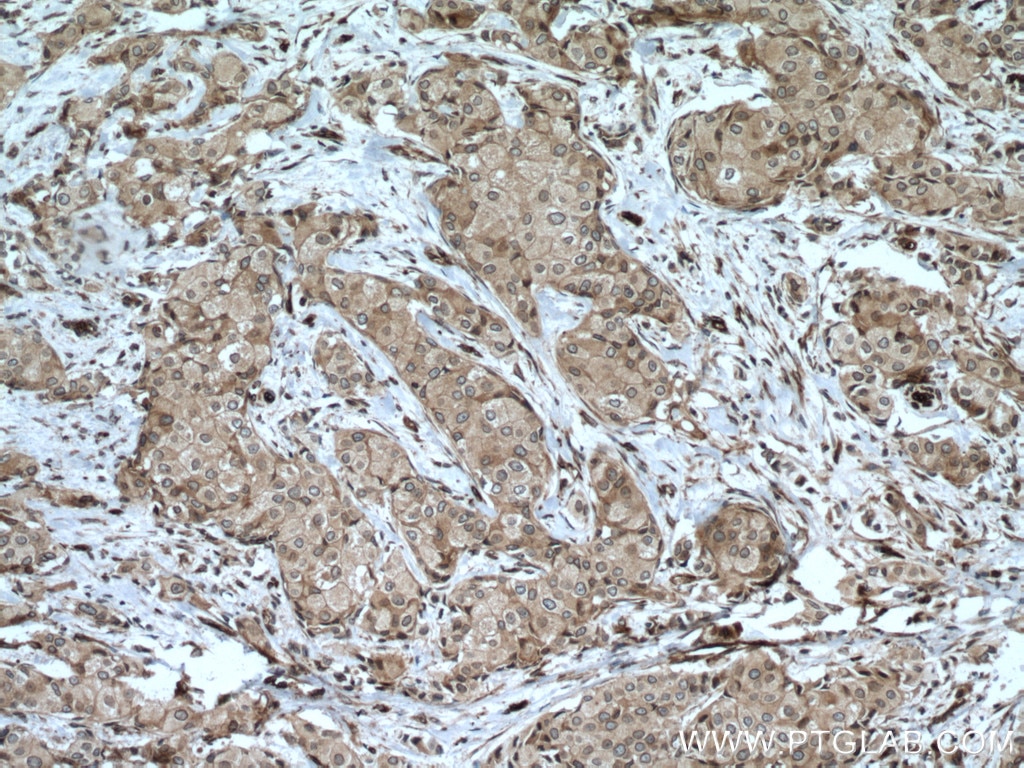Immunohistochemistry (IHC) staining of human breast cancer tissue using NUP98-NUP96 Polyclonal antibody (12329-1-AP)