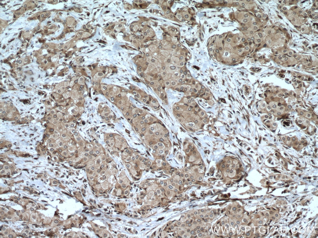 IHC staining of human breast cancer using 12329-1-AP