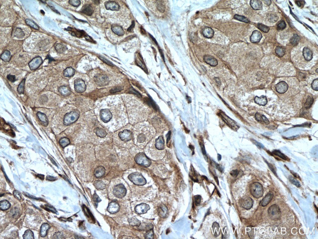 Immunohistochemistry (IHC) staining of human breast cancer tissue using NUP98-NUP96 Polyclonal antibody (12329-1-AP)