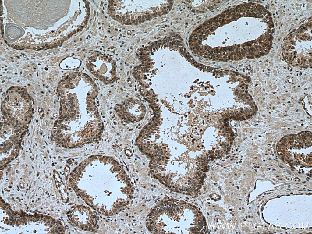 Immunohistochemistry (IHC) staining of human prostate cancer tissue using NUPR1 Polyclonal antibody (15056-1-AP)