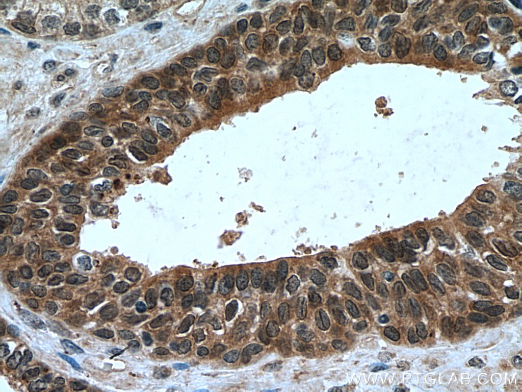 Immunohistochemistry (IHC) staining of human prostate cancer tissue using NUPR1 Polyclonal antibody (15056-1-AP)