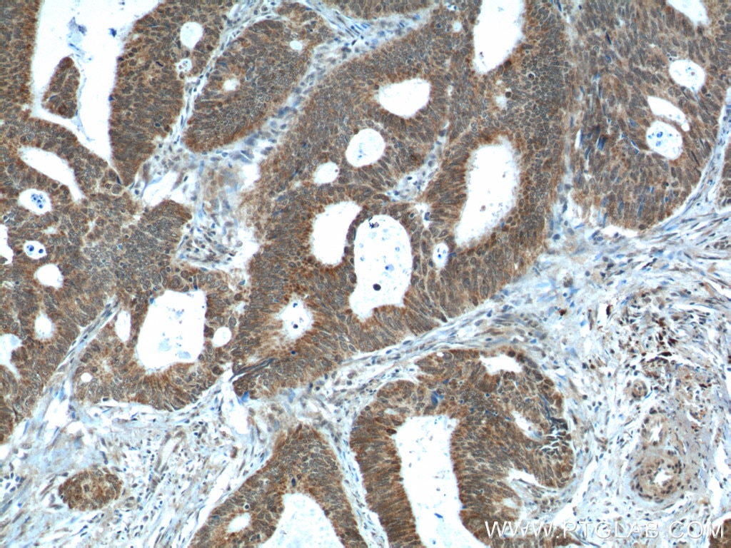 Immunohistochemistry (IHC) staining of human colon cancer tissue using NUPR1 Polyclonal antibody (15056-1-AP)