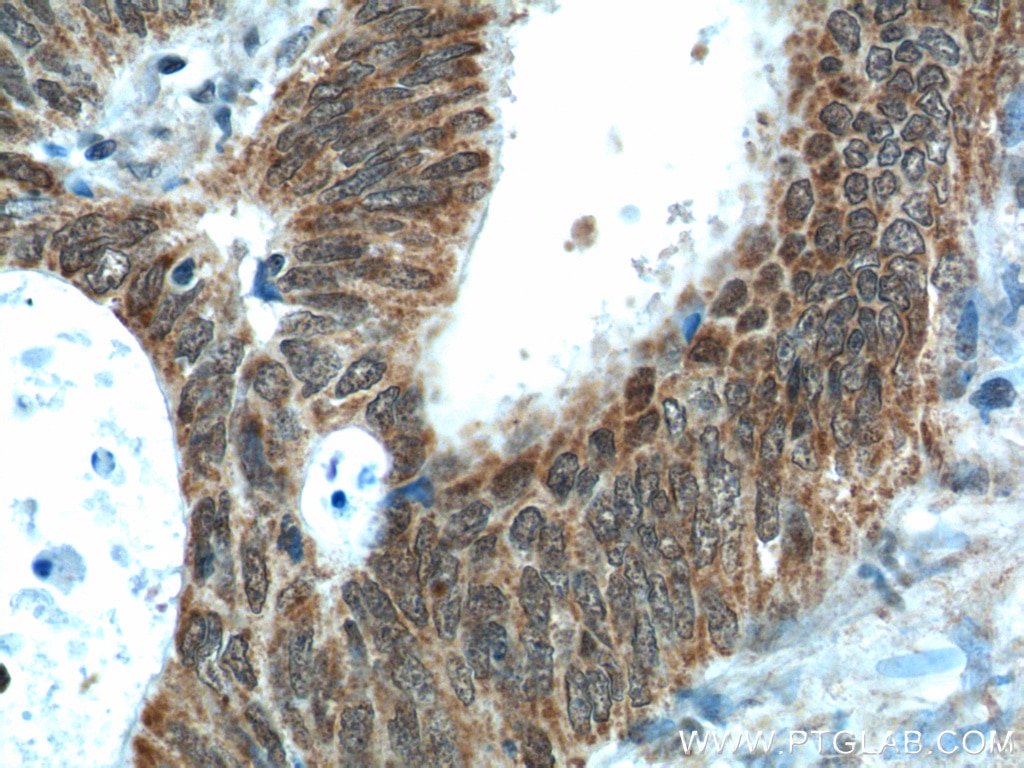 Immunohistochemistry (IHC) staining of human colon cancer tissue using NUPR1 Polyclonal antibody (15056-1-AP)