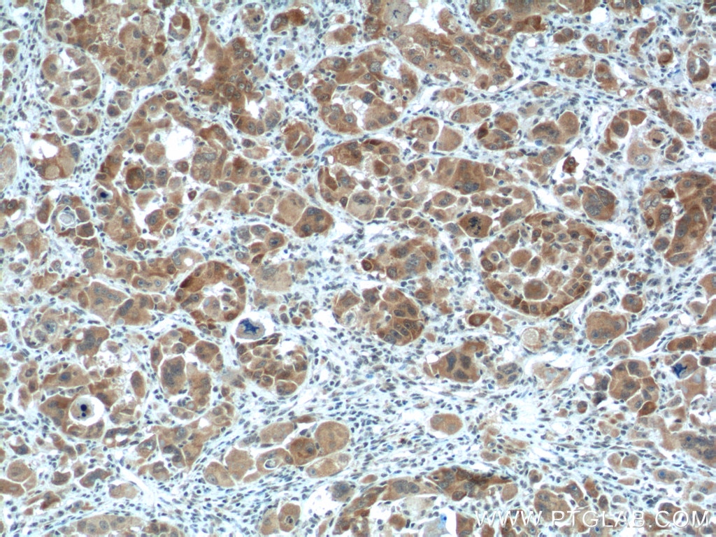 Immunohistochemistry (IHC) staining of human liver cancer tissue using NUPR1 Polyclonal antibody (15056-1-AP)