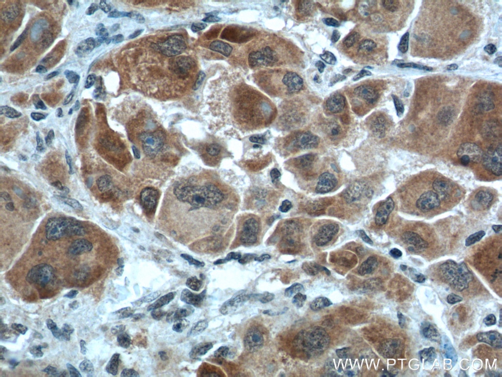 Immunohistochemistry (IHC) staining of human liver cancer tissue using NUPR1 Polyclonal antibody (15056-1-AP)