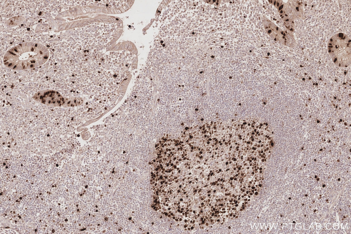 Immunohistochemistry (IHC) staining of human appendicitis tissue using NUSAP1 Polyclonal antibody (12024-1-AP)