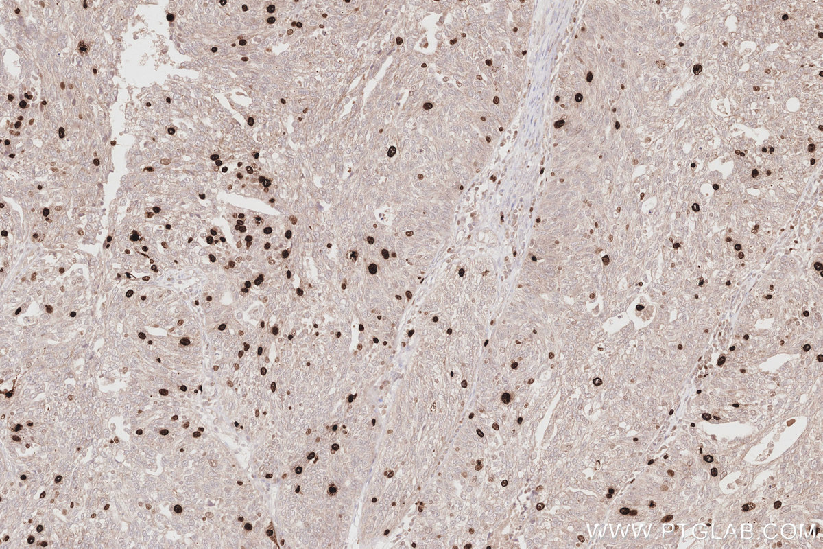 Immunohistochemistry (IHC) staining of human ovary cancer tissue using NUSAP1 Polyclonal antibody (12024-1-AP)