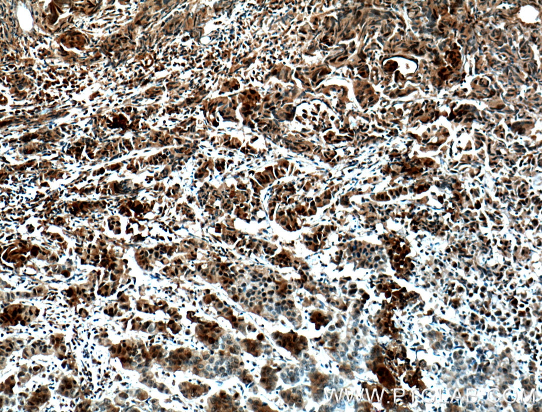 Immunohistochemistry (IHC) staining of human prostate cancer tissue using NUSAP1 Polyclonal antibody (12024-1-AP)