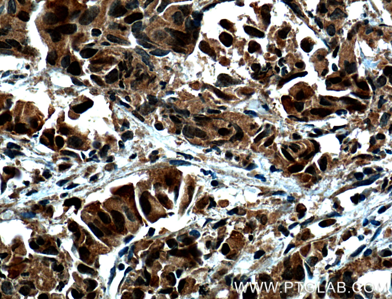 Immunohistochemistry (IHC) staining of human prostate cancer tissue using NUSAP1 Polyclonal antibody (12024-1-AP)