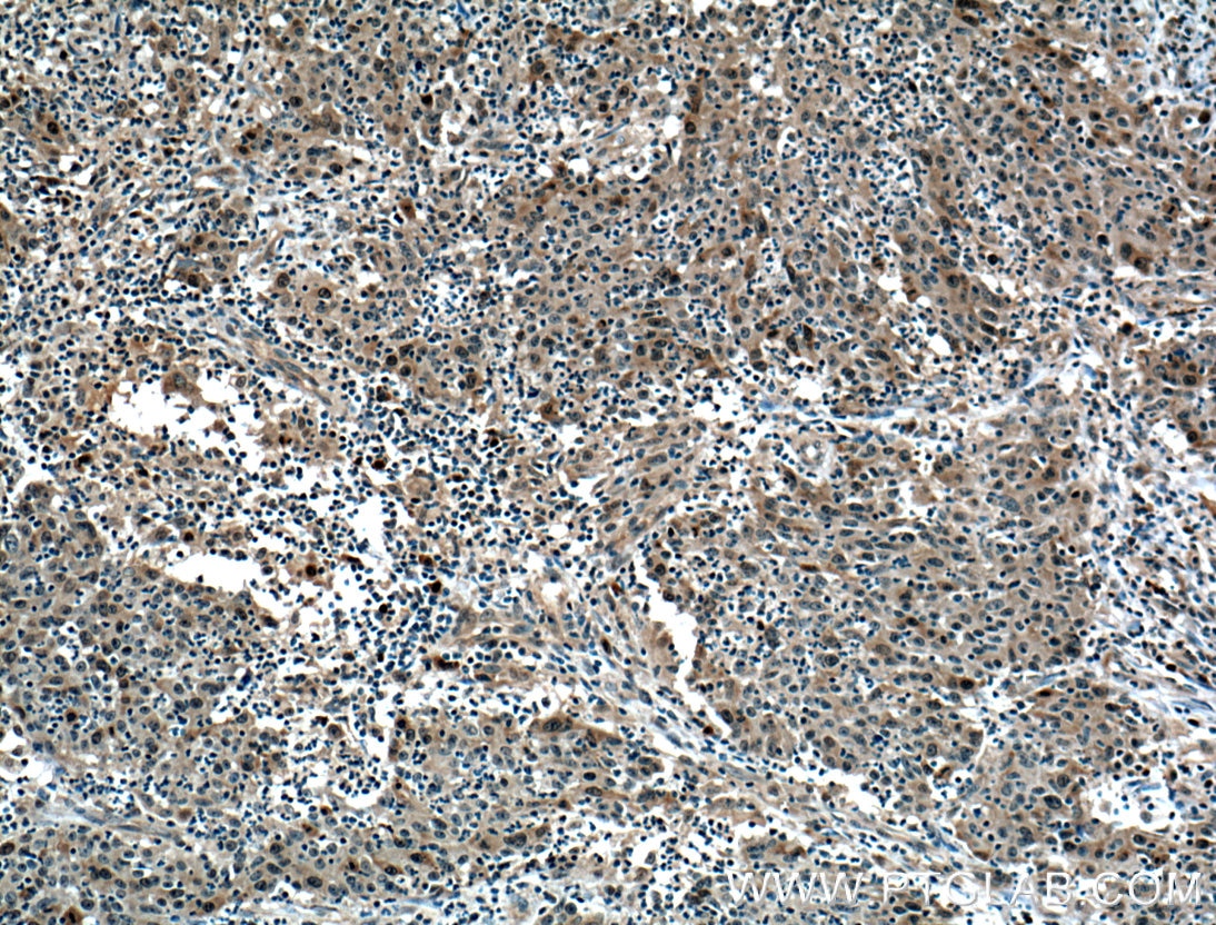 Immunohistochemistry (IHC) staining of human colon cancer tissue using NUSAP1 Polyclonal antibody (12024-1-AP)