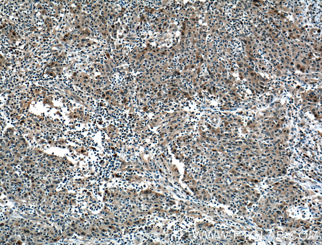 IHC staining of human colon cancer using 12024-1-AP