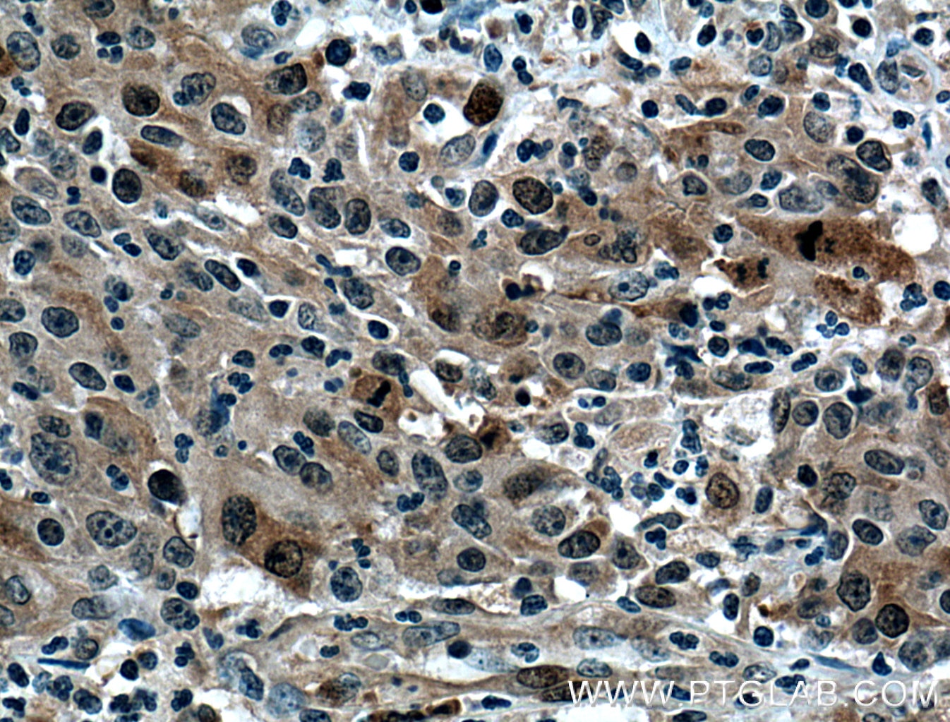 Immunohistochemistry (IHC) staining of human colon cancer tissue using NUSAP1 Polyclonal antibody (12024-1-AP)