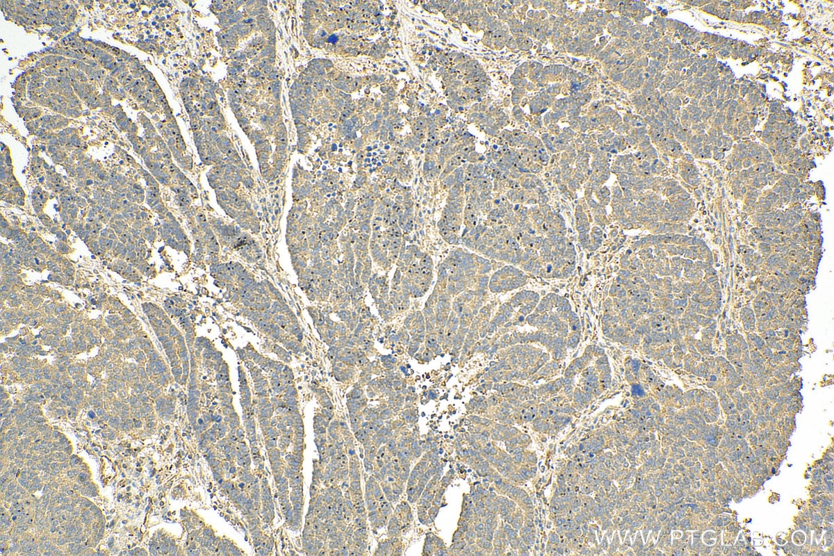 Immunohistochemistry (IHC) staining of human ovary tumor tissue using NTF2 Polyclonal antibody (15538-1-AP)