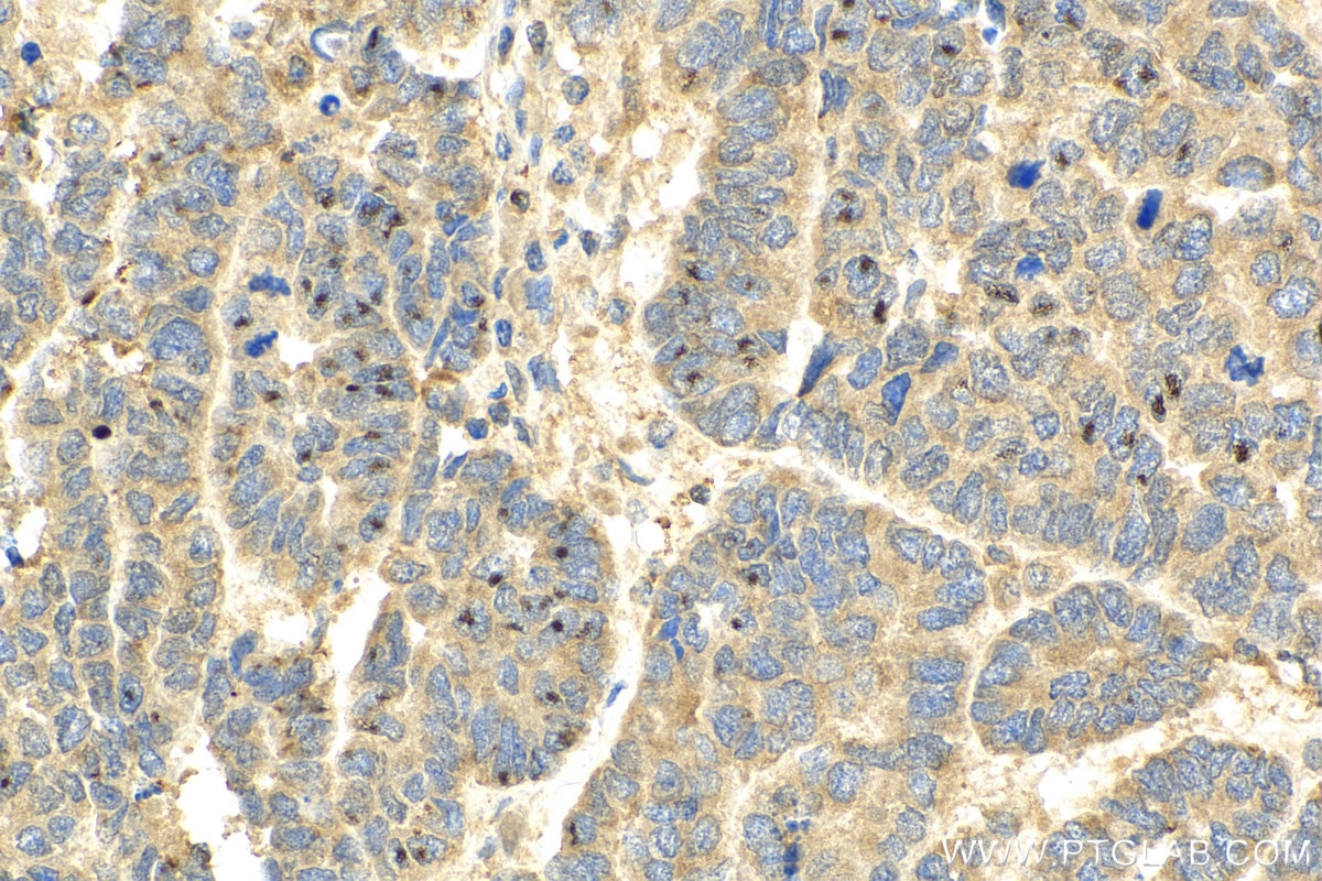 Immunohistochemistry (IHC) staining of human ovary tumor tissue using NTF2 Polyclonal antibody (15538-1-AP)