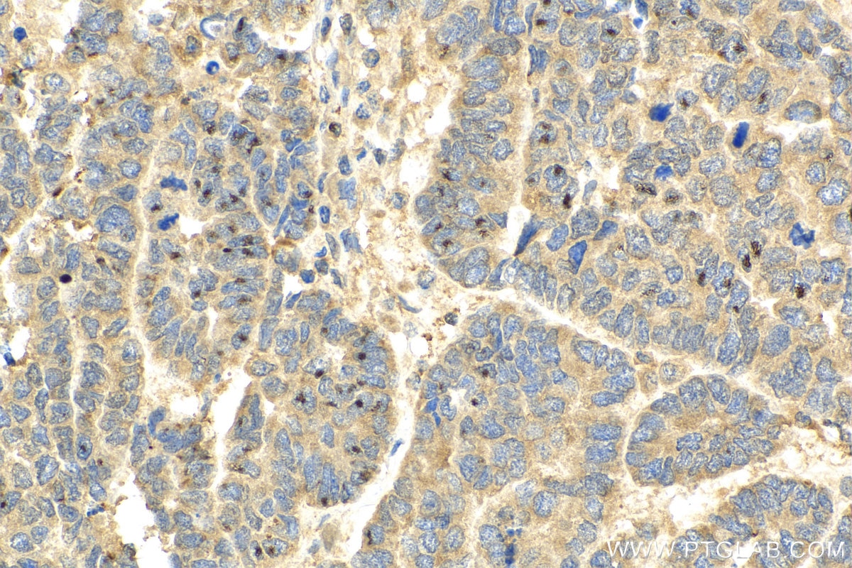 IHC staining of human ovary tumor using 15538-1-AP