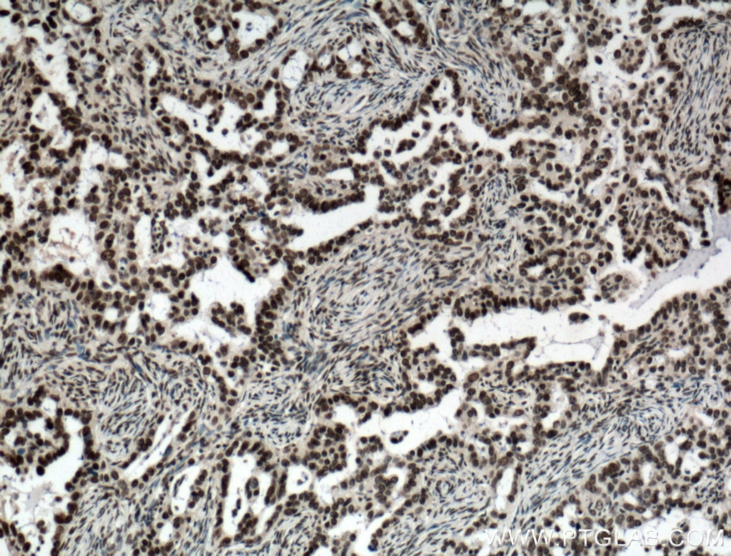 Immunohistochemistry (IHC) staining of human ovary tumor tissue using NTF2 Monoclonal antibody (66063-1-Ig)