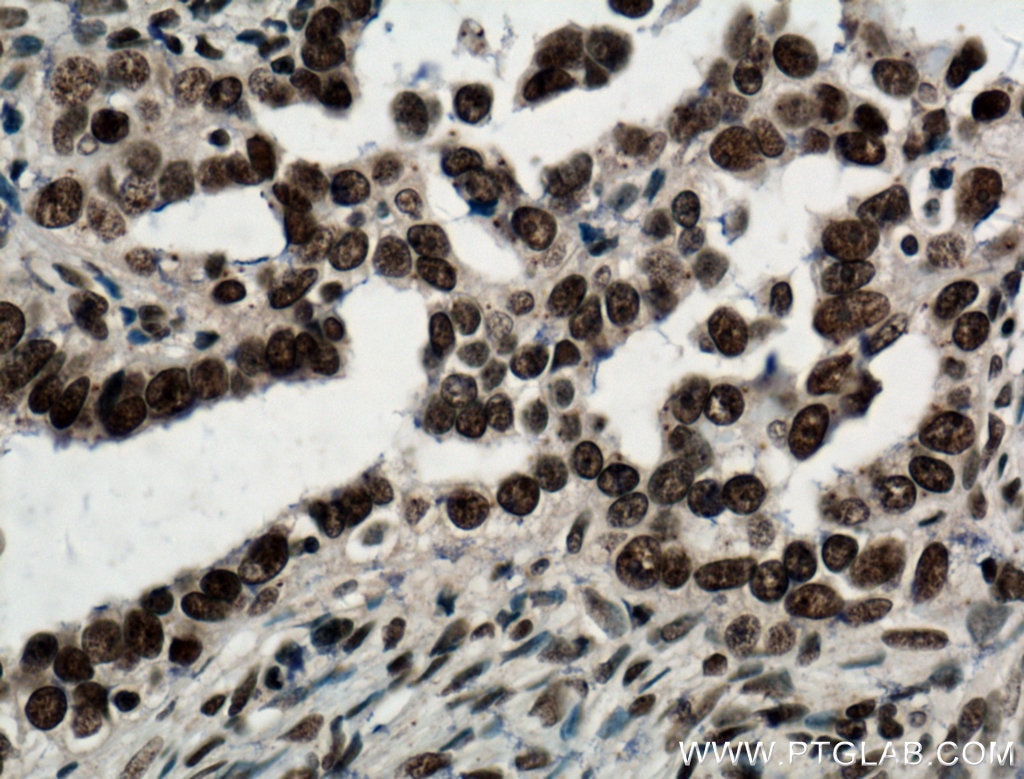 Immunohistochemistry (IHC) staining of human ovary tumor tissue using NTF2 Monoclonal antibody (66063-1-Ig)