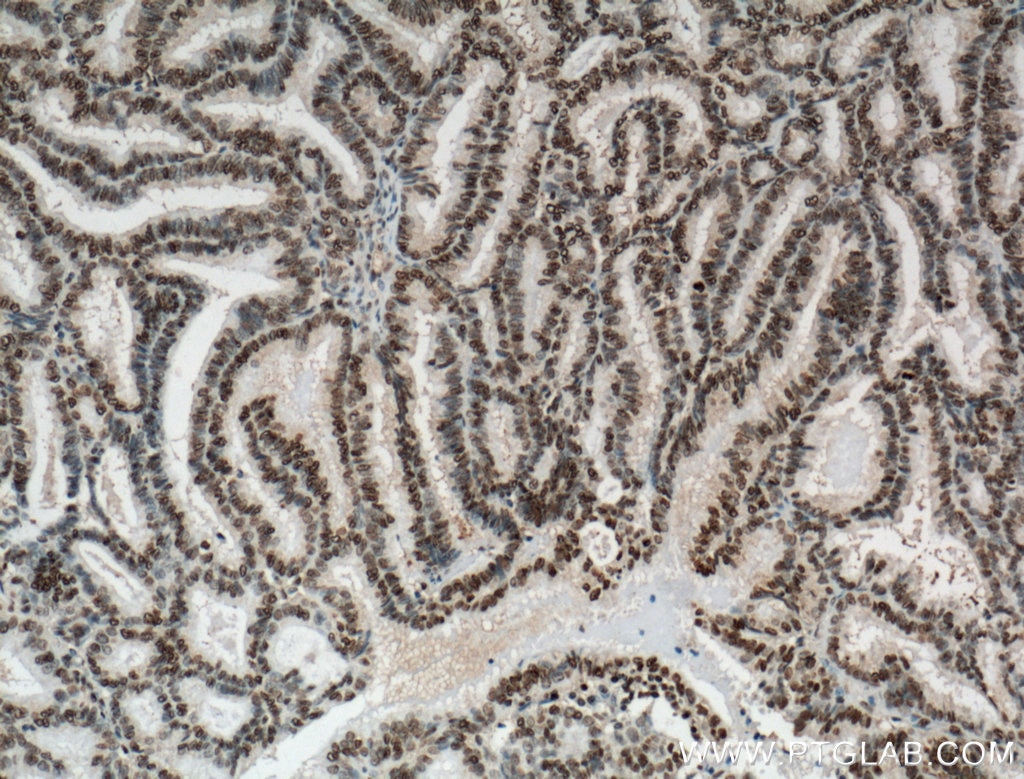 Immunohistochemistry (IHC) staining of human breast cancer tissue using NTF2 Monoclonal antibody (66063-1-Ig)