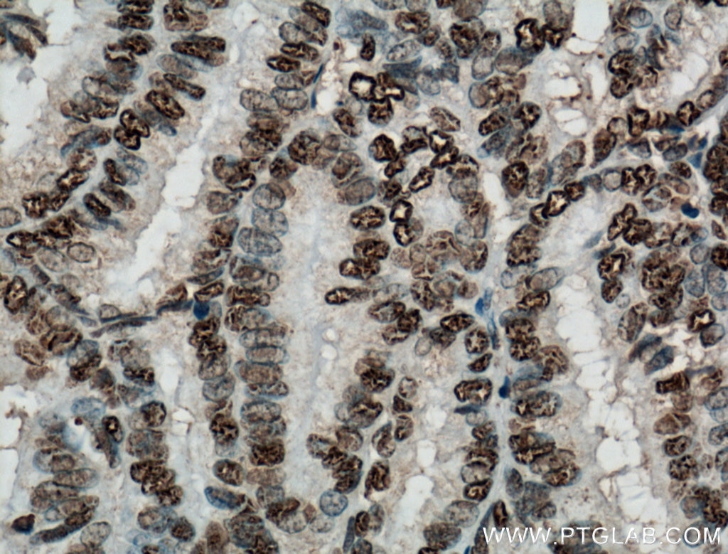 Immunohistochemistry (IHC) staining of human breast cancer tissue using NTF2 Monoclonal antibody (66063-1-Ig)