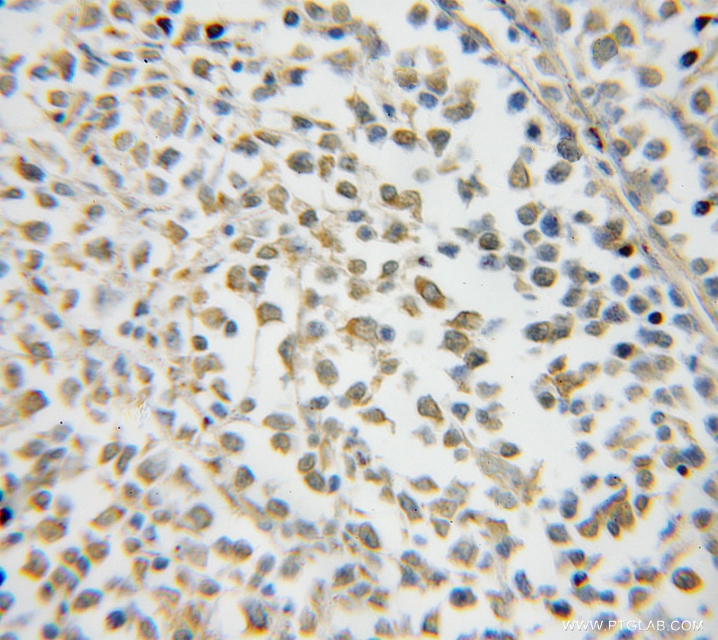Immunohistochemistry (IHC) staining of human lymphoma tissue using NXF2 Polyclonal antibody (12185-1-AP)