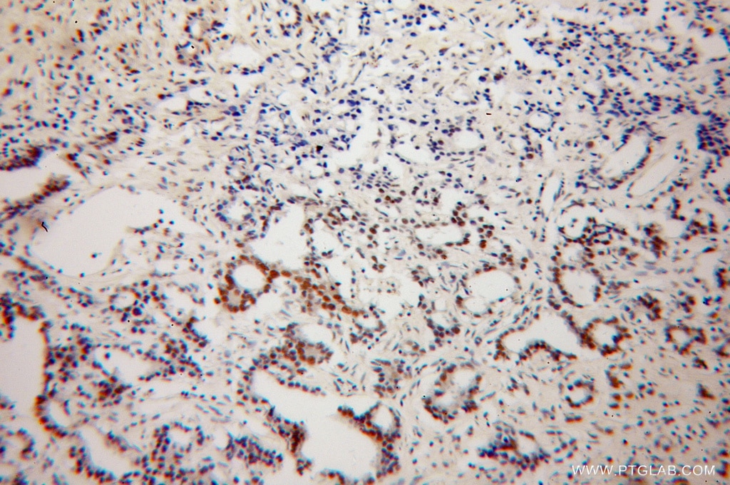 Immunohistochemistry (IHC) staining of human gliomas tissue using NXF3 Polyclonal antibody (13275-1-AP)