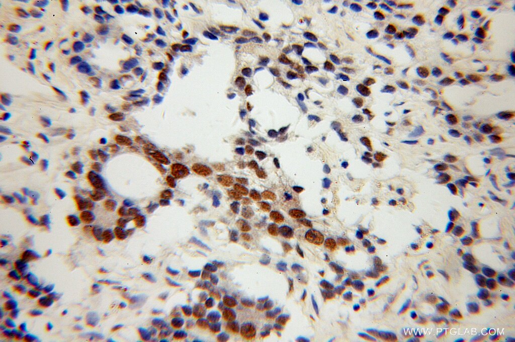 Immunohistochemistry (IHC) staining of human gliomas tissue using NXF3 Polyclonal antibody (13275-1-AP)