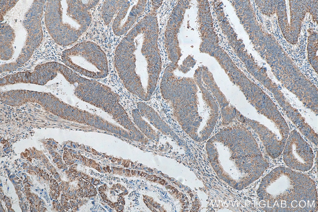 Immunohistochemistry (IHC) staining of human colon cancer tissue using NXN Polyclonal antibody (16128-1-AP)