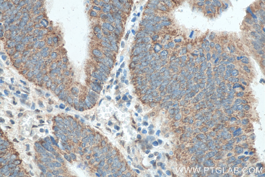 Immunohistochemistry (IHC) staining of human colon cancer tissue using NXN Polyclonal antibody (16128-1-AP)