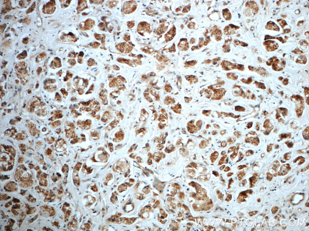 Immunohistochemistry (IHC) staining of human breast cancer tissue using TXNL6 Polyclonal antibody (11203-1-AP)