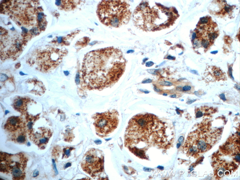 Immunohistochemistry (IHC) staining of human breast cancer tissue using TXNL6 Polyclonal antibody (11203-1-AP)