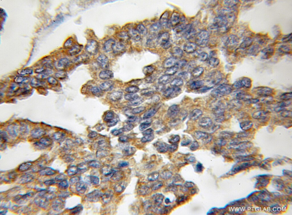 Immunohistochemistry (IHC) staining of human breast cancer tissue using TXNL6 Polyclonal antibody (11203-1-AP)