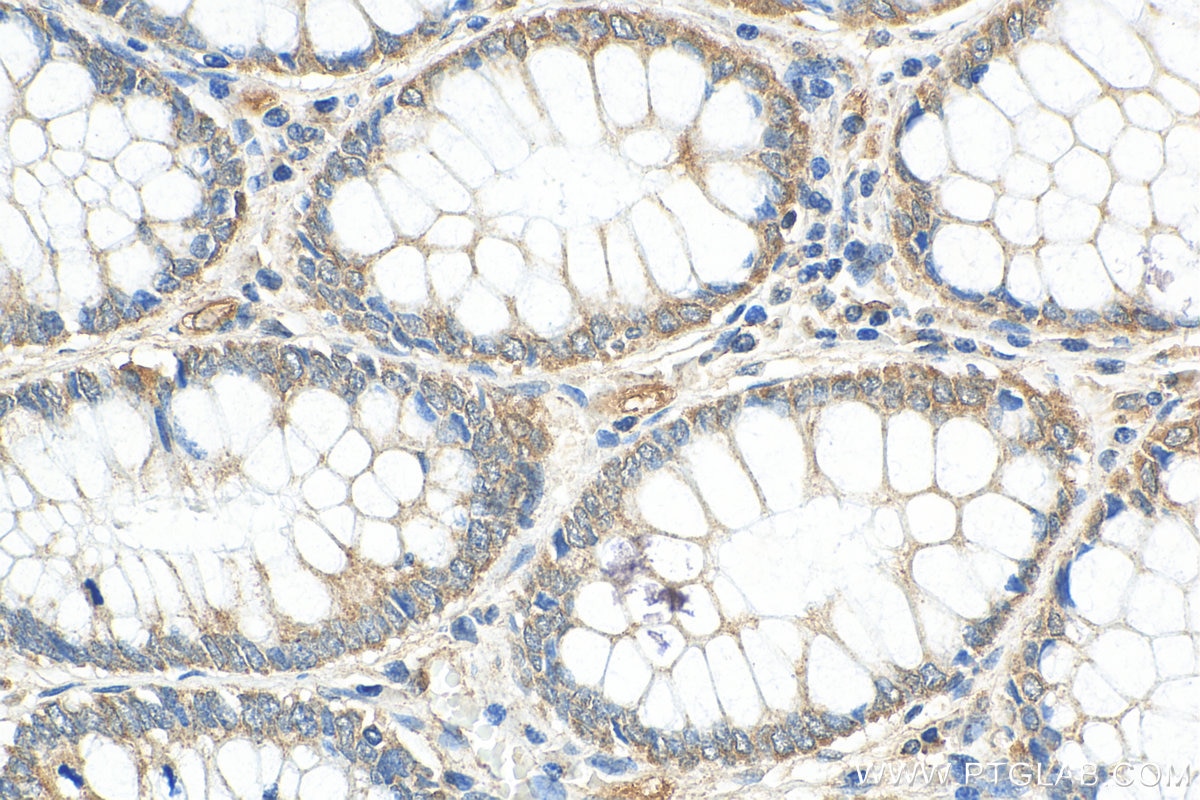 IHC staining of human colon cancer using 12136-1-AP